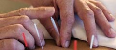 acupuntura-brasilia-1483389921