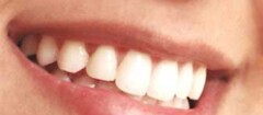 implantes-dentarios-brasilia-1483394356