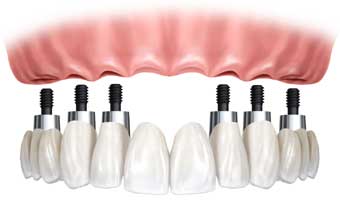 Prodal Prótese Dentária Santo Antônio - Foto 1